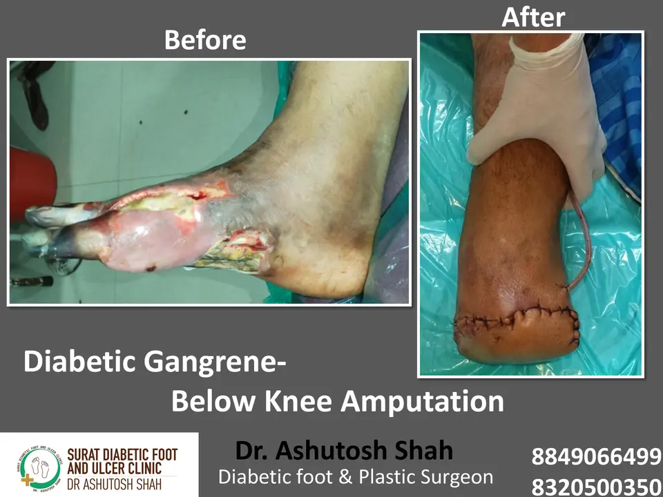 Diabetic Foot  PPT sunita.pptx-17.webp